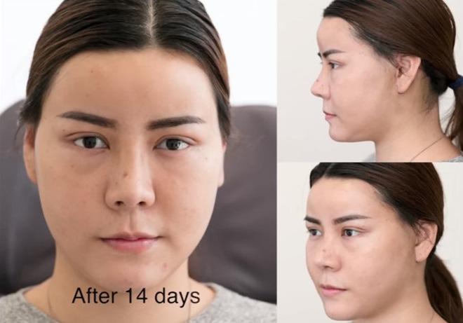 Không hài lòng với vẻ ngoài của mình, thiếu nữ lột xác xinh ngất ngây sau khi chi 1,3 tỷ phẫu thuật thẩm mỹ - Ảnh 4.