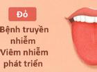 Màu lưỡi nói lên tình trạng sức khỏe của bạn thế nào?