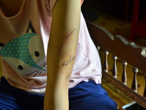 Tâm sự của người phụ nữ sau li hôn vẫn bị chồng đánh nhập viện