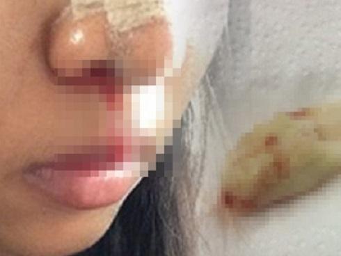 Sau 2 năm thiếu nữ nâng mũi, bác sĩ kinh ngạc gắp ra cục gạc-2