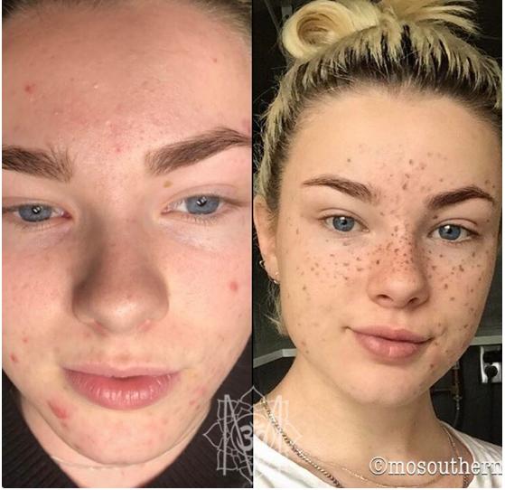 Mốt xăm tàn nhang đáng yêu trên mặt đang khiến phái đẹp thế giới điên đảo-3