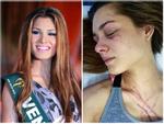 Nhan sắc mười phân vẹn mười của hoa hậu Venezuela bị đánh dập mặt