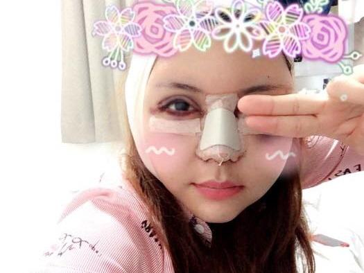 Học trò Đàm Vĩnh Hưng công khai gương mặt 'đập đi làm lại' còn đỏ tấy, sưng húp