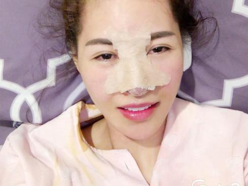 Sau 6 ca phẫu thuật, Quế Vân tiếp tục tung clip sửa mũi ai xem cũng shock