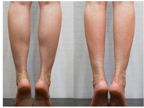 Chỉ 2 phút mỗi ngày, tôi đã giảm được đến 4,5cm mỡ bắp chân sau 1 tháng, ai không tin cứ làm theo cách này