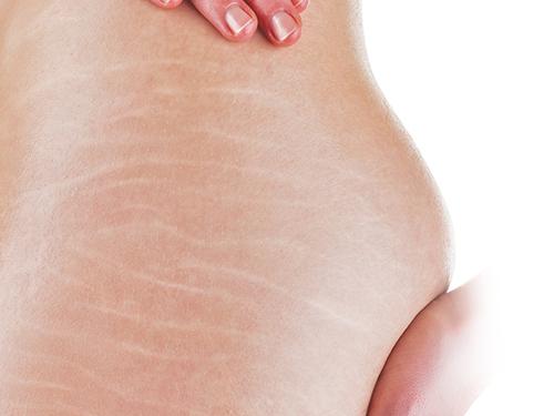 2 mẹo trị rạn da hiệu quả sau sinh hiệu quả nhanh nhất -5