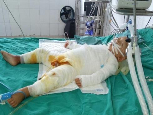 Mẹ ngất lịm khi nghe tin con 18 tháng tuổi ngã vào nồi nước nóng