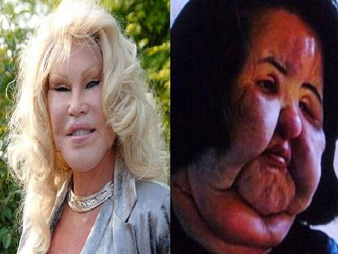 Những 'dị nhân' đời thực vì hậu quả của biến chứng phẫu thuật thẩm mỹ