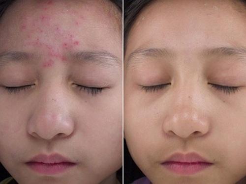 Cách chữa mụn nhanh nhất hiệu quả tại nhà -3