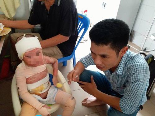 Hiện tại, bé Kem đang được điều trị ở viện Bỏng