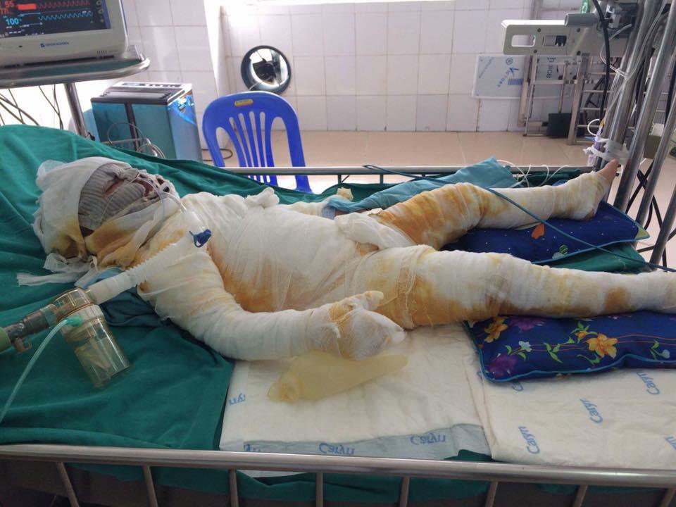 Tin nóng trong ngày 28/7: Bé gái 4 tuổi bị bỏng cồn nướng mực cháy rực như ngọn đuốc-1