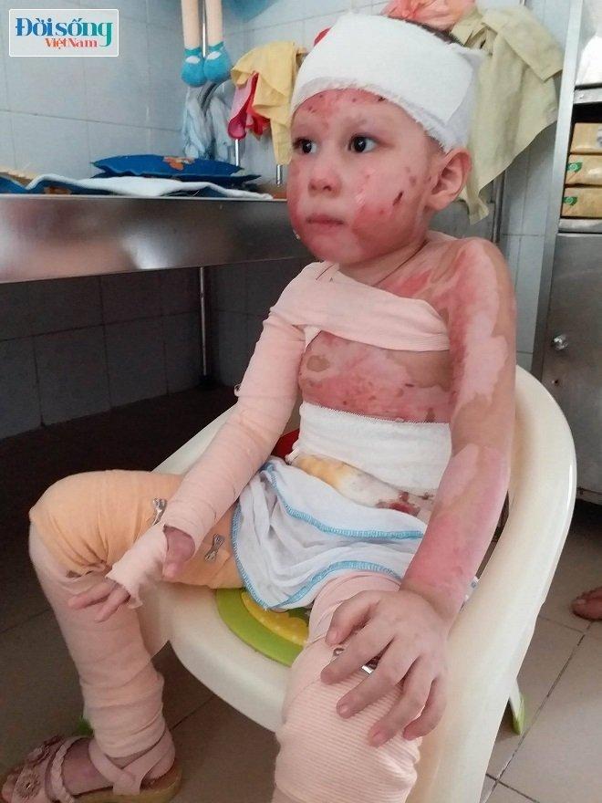 Tin nóng trong ngày 28/7: Bé gái 4 tuổi bị bỏng cồn nướng mực cháy rực như ngọn đuốc-2