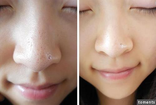 Cách trị mụn đầu đen tại nhà sạch bách từ quả chanh vài ngàn đồng-1