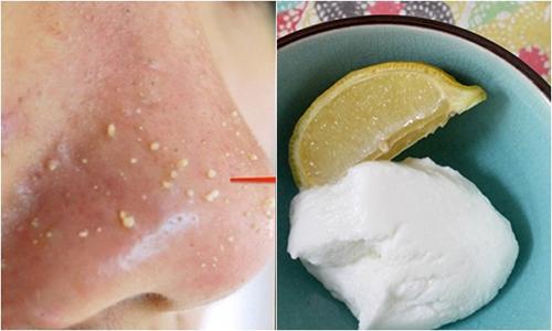 Cách trị mụn đầu đen tại nhà sạch bách từ quả chanh vài ngàn đồng-5