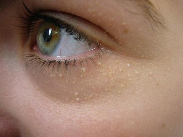 Với 2 ngàn đồng có ngay 2 cách trị mụn thịt quanh mắt 'một đi không trở lại'-1