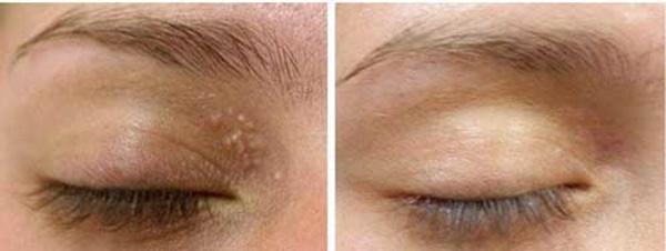 Với 2 ngàn đồng có ngay 2 cách trị mụn thịt quanh mắt 'một đi không trở lại'-8