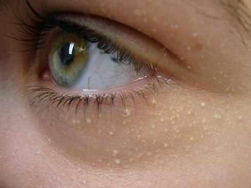 Tuyệt đối tránh xa vùng 'tam giác tử thần' và những sai lầm khi nặn mụn-6