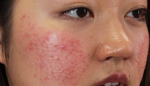 Đây là cách cấp cứu, phục hồi da do dùng kem trộn, nhiễm độc corticoid 'chuẩn' nhất, các nàng nên làm theo ngay và luôn!-1