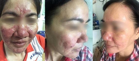 Đây là cách cấp cứu, phục hồi da do dùng kem trộn, nhiễm độc corticoid 'chuẩn' nhất, các nàng nên làm theo ngay và luôn!-2