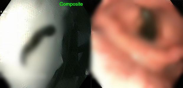 Phát hiện con vắt dài 10cm núp trong khí quản nữ bệnh nhân-1