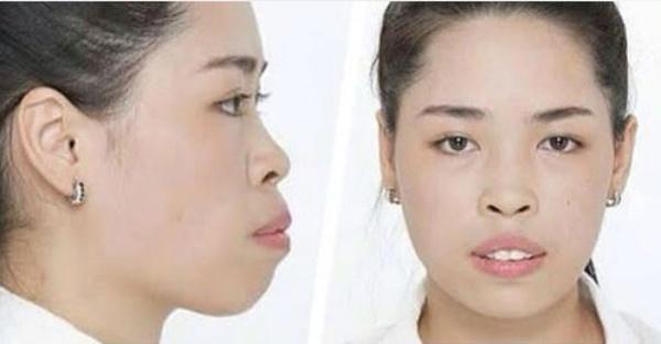 Ngoài Đức Phúc, không ít gương mặt đẹp ngỡ ngàng nhờ phẫu thuật thẩm mỹ-8