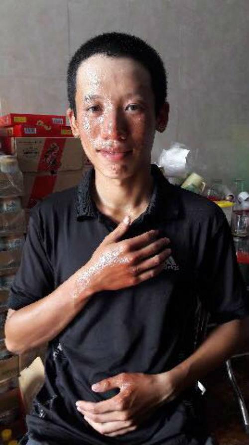 Tin nóng trong ngày 31/7: Đang xì xụp ăn mì cay, 9 khách hàng ở Hải Dương cháy sém mặt vì bếp ga mini phát nổ-1