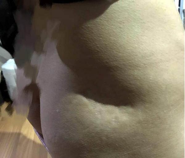 Hà Nội: Bỏ 29 triệu đồng tiêm nhau thai chữa lạc nội mạc tử cung tại spa, 1 phụ nữ bị teo mông?-3