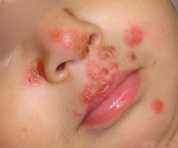 Bé trai 1 tuổi nhiễm loại virus cả đời không thể chữa khỏi chỉ vì nụ hôn của người lớn-2