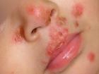Bé trai 1 tuổi nhiễm loại virus cả đời không thể chữa khỏi chỉ vì nụ hôn của người lớn
