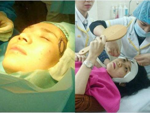 Cận cảnh quá trình phẫu thuật độn thái dương của Thanh Bi 'Người Phán Xử'