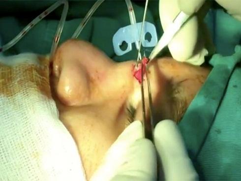 Sau 2 năm thiếu nữ nâng mũi, bác sĩ kinh ngạc gắp ra cục gạc-1