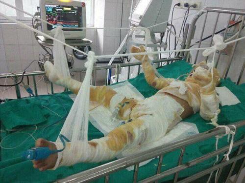 Tin nóng trong ngày 4/8: Tò mò xem nướng mực, bé trai 6 tuổi bỏng nặng phải treo tay và cắt chân-1