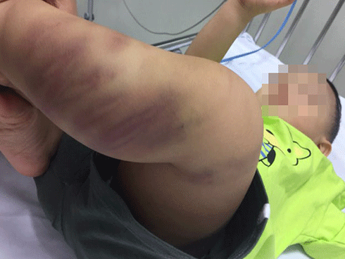 Bé trai hơn 1 tuổi bị đánh đập bầm tím, tổn thương vùng sinh dục