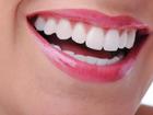 6 công thức làm trắng răng tự nhiên