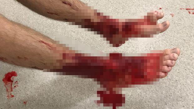 Đang tắm biển thấy chân ngứa ran, máu chảy không ngừng-1