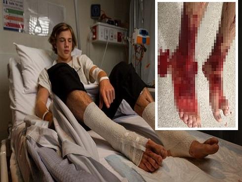 Đang tắm biển thấy chân ngứa ran, máu chảy không ngừng