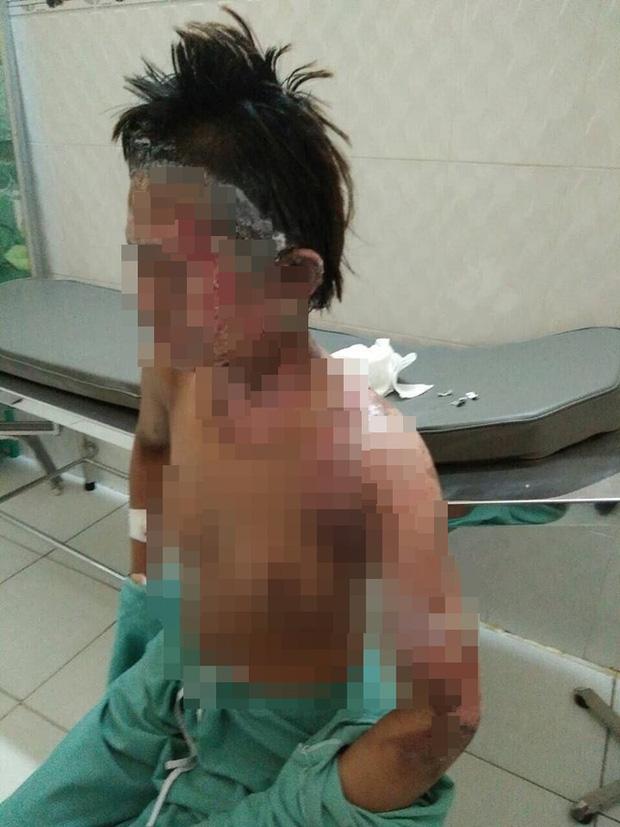 Giận vợ, chồng tưới xăng dọa đốt nhà, lửa bùng cháy gây bỏng cho cả đứa con mới hơn 2 tuổi-2