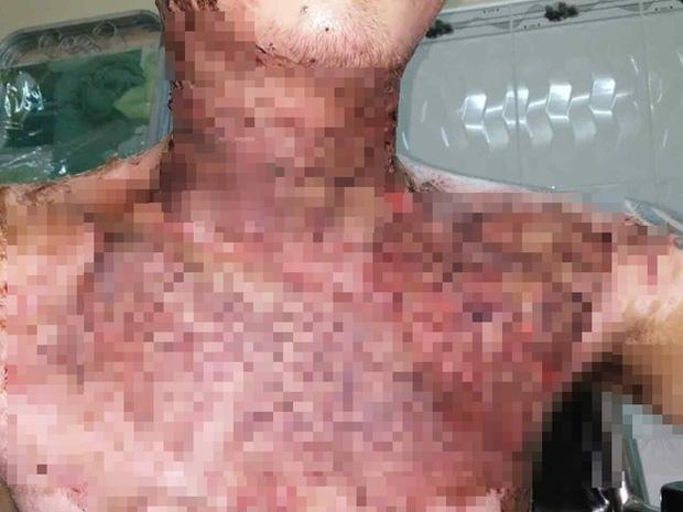 Giận vợ, chồng tưới xăng dọa đốt nhà, lửa bùng cháy gây bỏng cho cả đứa con mới hơn 2 tuổi-5