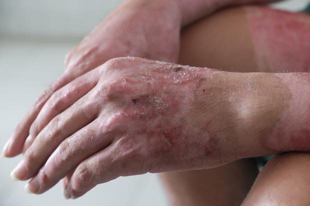 Giận vợ, chồng tưới xăng dọa đốt nhà, lửa bùng cháy gây bỏng cho cả đứa con mới hơn 2 tuổi-6