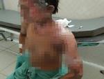 Đau đớn bé trai 18 tháng tuổi bị bỏng toàn thân vì ngã vào nồi nước nóng ở đám cưới-5