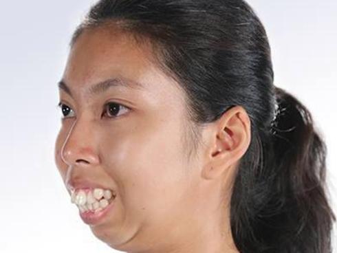 Vỡ mộng vì quá khứ xấu khó tin của loạt nam - nữ thần Thái Lan trước phẫu thuật thẩm mỹ