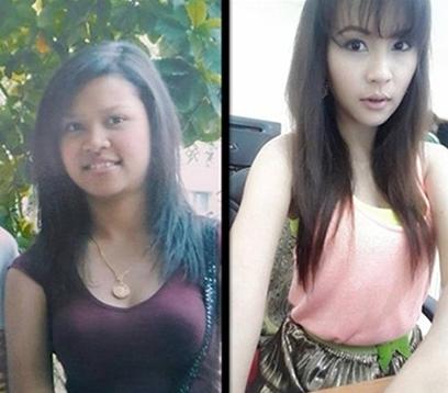 Những câu chuyện 'dở khóc dở cười' về phẫu thuật thẩm mỹ-1