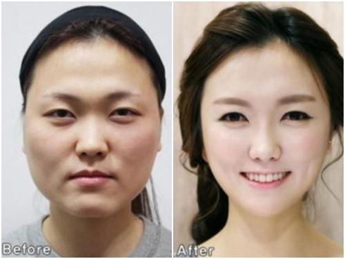 Những câu chuyện 'dở khóc dở cười' về phẫu thuật thẩm mỹ