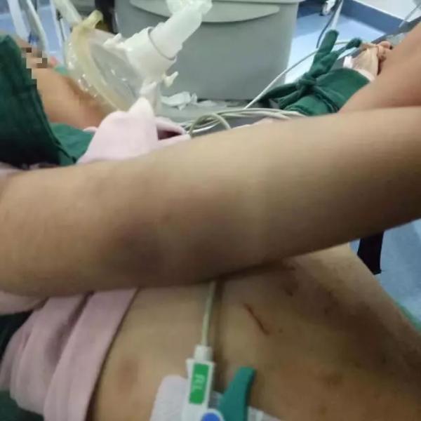 Bé gái 3 tuổi bị bỏng da đầu, kim đâm chi chít ở bụng từ những lần tra tấn dã man của mẹ kế-4