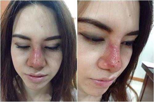 Tuyệt đối tránh xa vùng 'tam giác tử thần' và những sai lầm khi nặn mụn-1