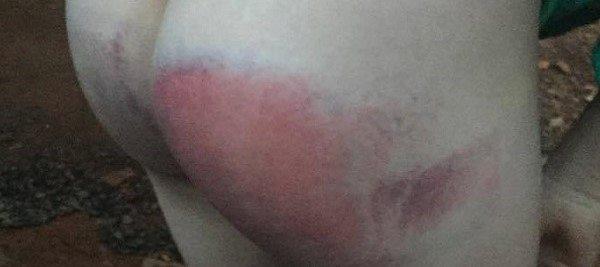 Bé gái 8 tuổi bị cô giáo dạy thêm đánh bầm tím mông-1