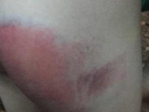 Bé gái 8 tuổi bị cô giáo dạy thêm đánh bầm tím mông