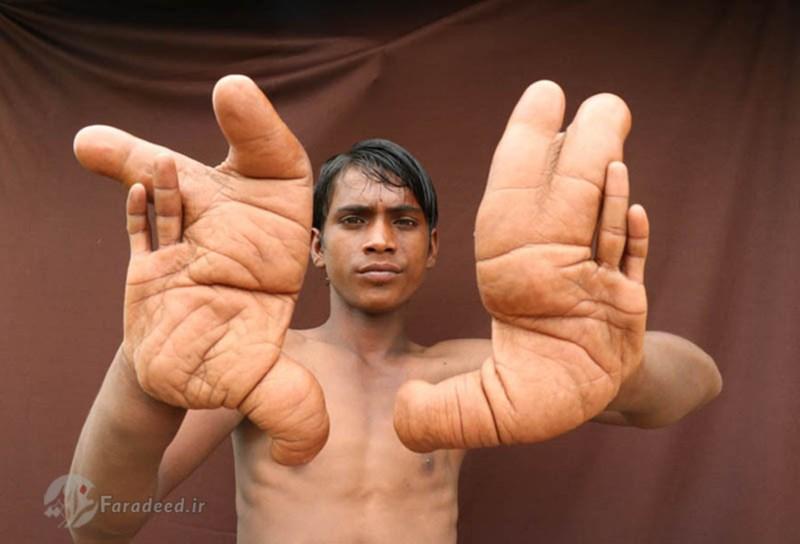 Nỗi khổ của cậu bé có 'đôi bàn tay quỷ'-1