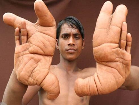 Nỗi khổ của cậu bé có 'đôi bàn tay quỷ'