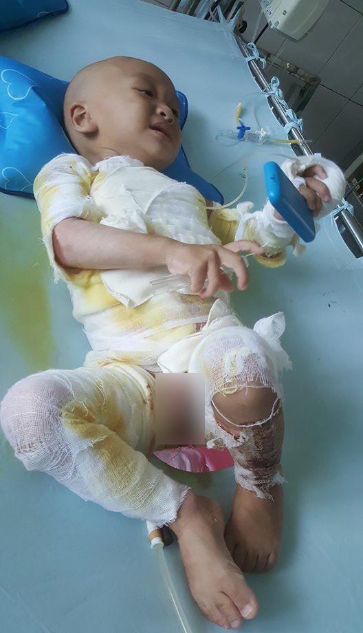 Đau đớn bé trai 18 tháng tuổi bị bỏng toàn thân vì ngã vào nồi nước nóng ở đám cưới-1